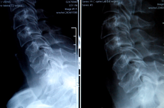 C5 Burst Fracture Recovery